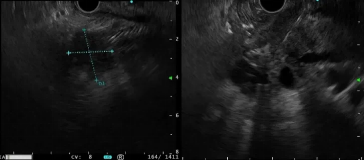 Pancreatic Cancer & Pancreatic Cancer FNA Pancreatic Cancer & Pancreatic Cancer FNA